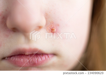 Child having impetigo skin infection chicken pox on face 134090620