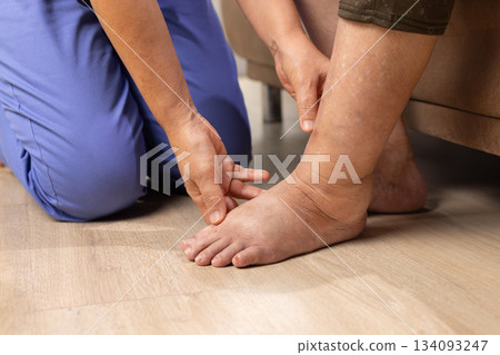 Elderly woman has edema or swelling foot. Elderly woman has edema or swelling foot. 134093247