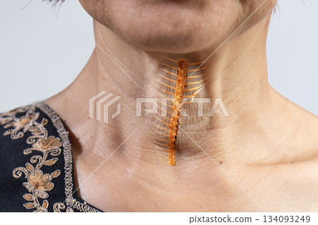 Senior woman is fish bone get stuck in throat. 134093249
