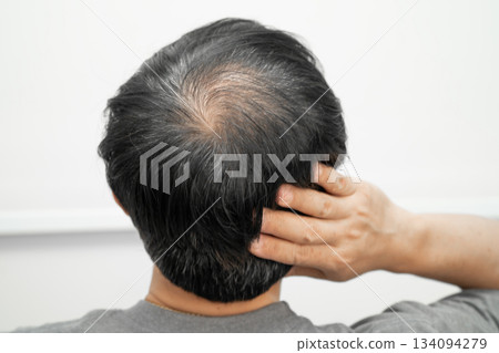 Bald head in man, hair loss treatment health problem. 134094279