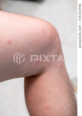 Close-up of spotted skin marks after playing in the sea during rainy season, natural outdoor effects Close-up of spotted skin marks after playing in the sea during rainy season, natural outdoor effects 134102498