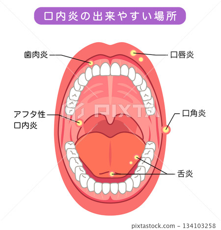 Areas where stomatitis is likely to occur: Inside the mouth, medical care Areas where stomatitis is likely to occur: Inside the mouth, medical care 134103258