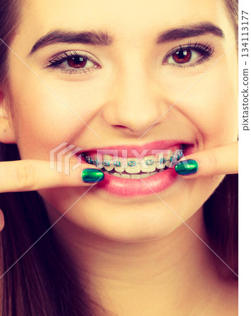 Woman showing her teeth with braces 134113177
