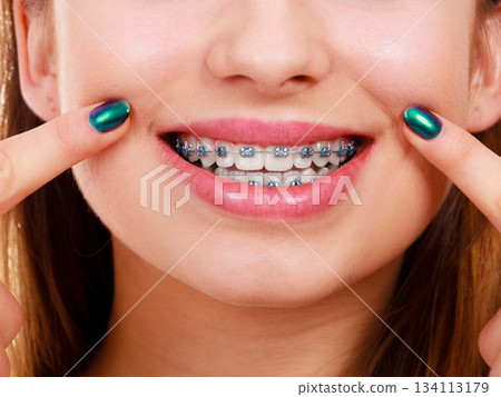 Woman showing her teeth with braces 134113179