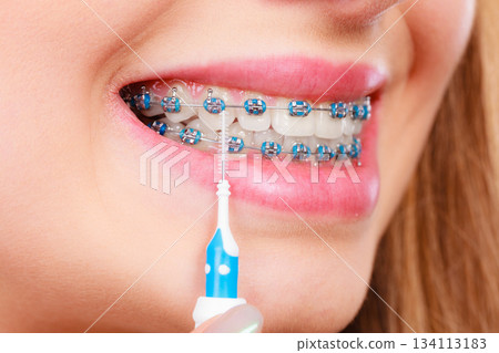 Woman smiling cleaning teeth with braces Woman smiling cleaning teeth with braces 134113183