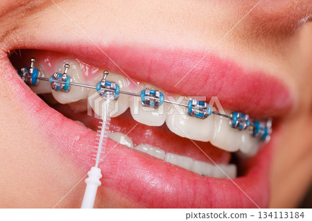 Woman brushing teeth with braces using brush Woman brushing teeth with braces using brush 134113184