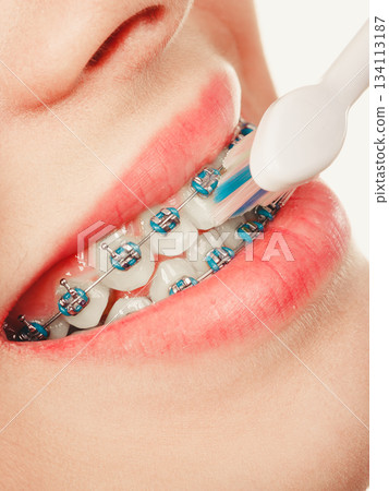 Woman smiling cleaning teeth with braces 134113187