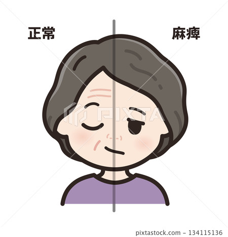 Illustration of left facial nerve paralysis_Comparison between normal and paralyzed Illustration of left facial nerve paralysis_Comparison between normal and paralyzed 134115136