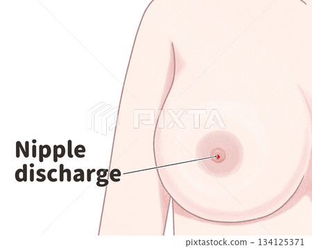 Breast cancer symptoms: nipple discharge - easy-to-understand English illustrations 134125371