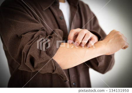 A middle-aged man suffering from dry, itchy skin 134131950