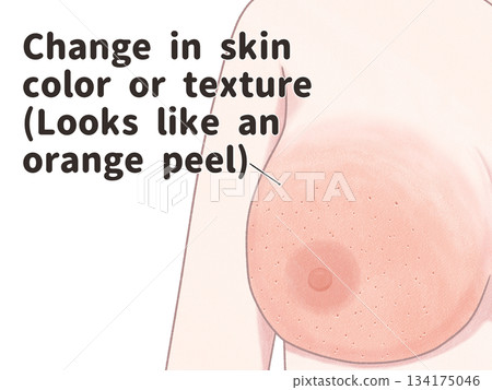 Symptoms of breast cancer: Skin changes - Easy-to-understand English illustrations Symptoms of breast cancer: Skin changes - Easy-to-understand English illustrations 134175046