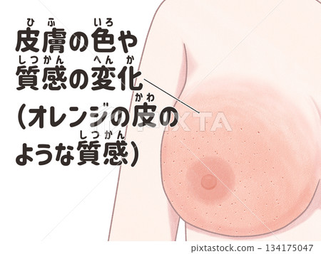 乳癌症狀：皮膚變化 - 簡單易懂的日文插圖 134175047