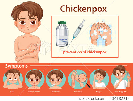 Chickenpox Symptoms and Prevention Vector Illustration for Education 134182214