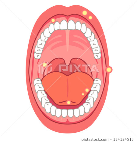 口腔炎易發部位：口腔內部、醫療護理 134184513