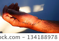 Post-Operative Wound and Stitches on Dark Skin Hand 134188978