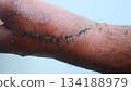 Post-Operative Wound and Stitches on Dark Skin Hand 134188979