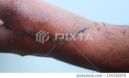Post-Operative Wound and Stitches on Dark Skin Hand 134188979