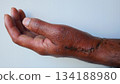 Post-Operative Wound and Stitches on Dark Skin Hand on white background 134188980