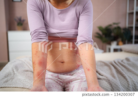 Woman showing red rash on arms and stomach 134200307