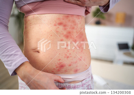 Woman showing red rash on stomach and side concept 134200308