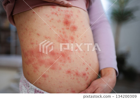 Adult person experiencing severe skin rash and irritation 134200309