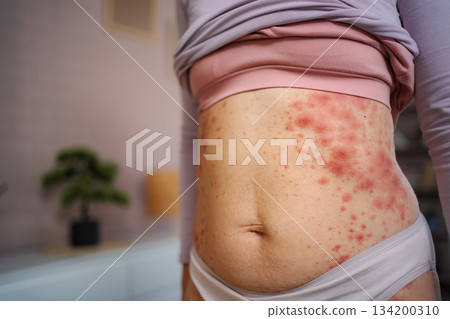 Woman showing red rash on stomach skin illness 134200310