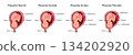 Placenta.  Part of placenta attaches abnormally to the myometrium. Three grades of attachment according to the depth: Accrete, increta, percreta. Medical vector illustration 134202920