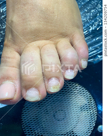 Closeup of Damaged Toenails Closeup of Damaged Toenails 134209754