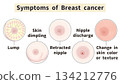 乳癌的症狀和外觀變化:簡明易懂的英文插圖 乳癌的症狀和外觀變化:簡明易懂的英文插圖 134212776