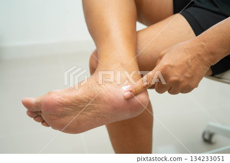Asian woman check feet with crack and dry heel skin, Diabetic Foot. 134233051
