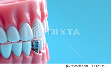 Dental implant with a tooth on a blue background, illustrating concepts of dentistry and healthy teeth 134249528