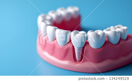 Image of a dental implant with a tooth on a blue background, highlighting dental care and health 134249529