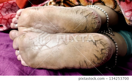 Close-Up of Cracked Heels and Bare Feet 134253700