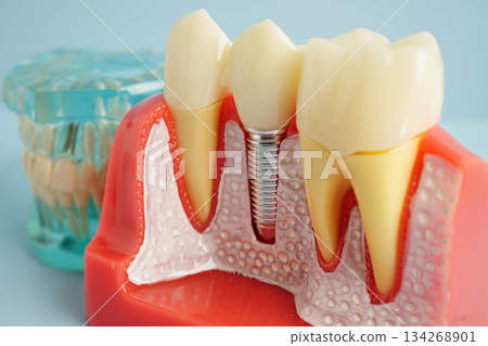 Dental implant, artificial tooth roots into jaw, root canal of dental treatment, gum disease, teeth model for dentist studying about dentistry. Dental implant, artificial tooth roots into jaw, root canal of dental treatment, gum disease, teeth model for dentist studying about dentistry. 134268901