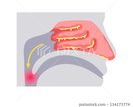 Postnasal drip poster 134273774