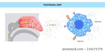 Postnasal drip poster Postnasal drip poster 134273779