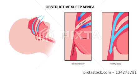 Obstructive sleep apnea 134273781