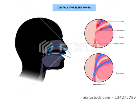 Obstructive sleep apnea Obstructive sleep apnea 134273789