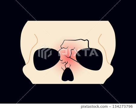 Nasal fracture poster 134273796