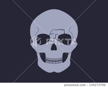 Nasal fracture poster 134273799