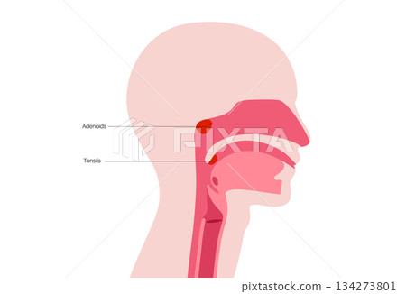 Adenotonsillar disease poster Adenotonsillar disease poster 134273801