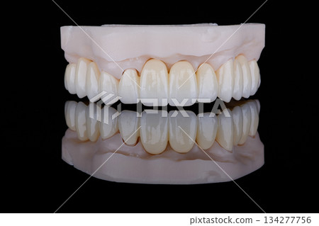 High-quality full-arch dental bridge made of zirconium for fixation to upper jaw. High-quality full-arch dental bridge made of zirconium for fixation to upper jaw. 134277756