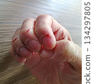 手指乾裂皸裂 134297805