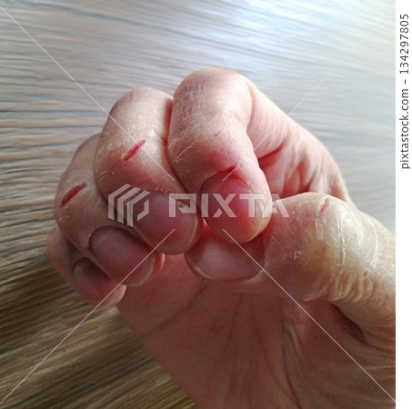 手指乾裂皸裂 134297805