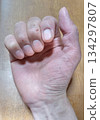 手部乾裂 134297807
