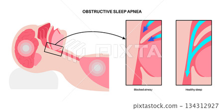 Obstructive sleep apnea 134312927