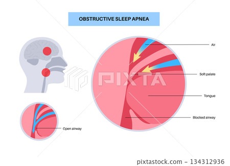 Obstructive sleep apnea Obstructive sleep apnea 134312936
