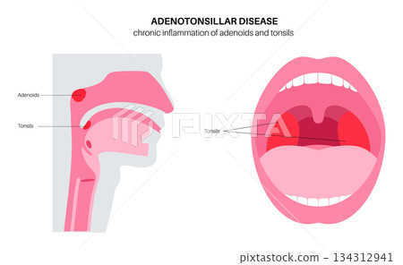 Adenotonsillar disease poster 134312941