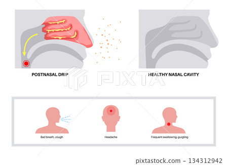 Postnasal drip poster Postnasal drip poster 134312942