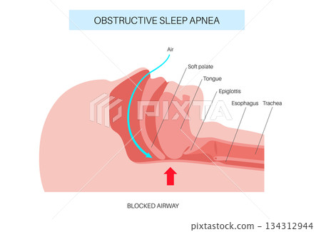 Obstructive sleep apnea 134312944